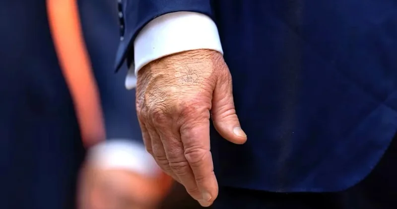 Trampın əllərindəki mavi ləkələrin səbəbi nədir? Özü açıqladı