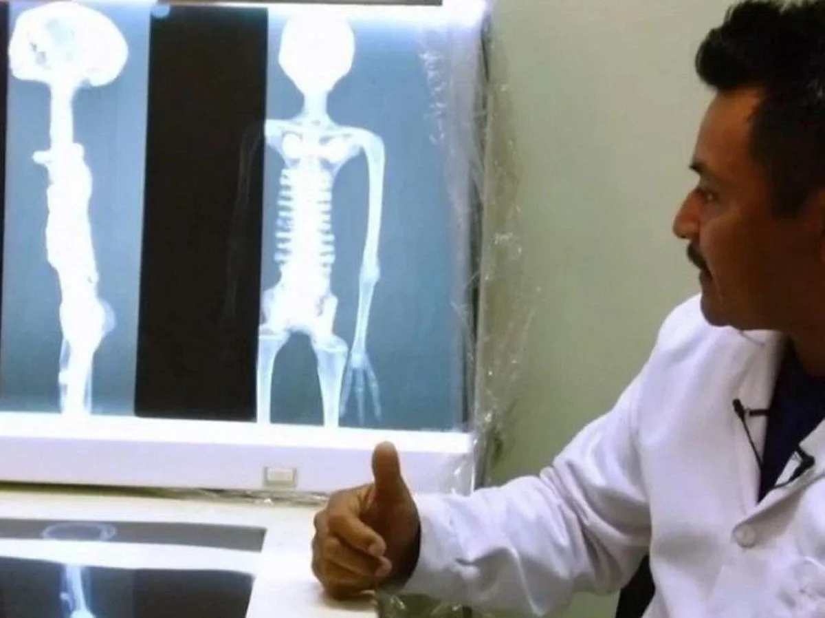 Nazca mumiyasının bədənindən müəmmalı implant çıxarıldı