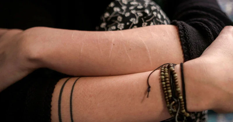 İsveçdə yeniyetmə qızlar arasında özünə xəsarət yetirmə halları artır