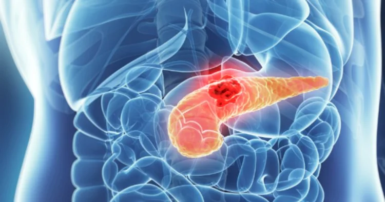 Mədəaltı vəzi xərçəngi ilə bağlı TARİXİ YENİLİK