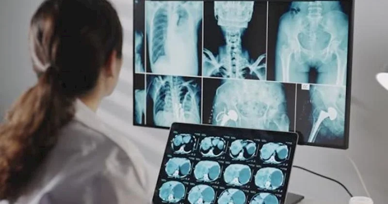 Niyə xərçəngdən sağalanların Alzheimerə tutulma ehtimalı daha azdır?