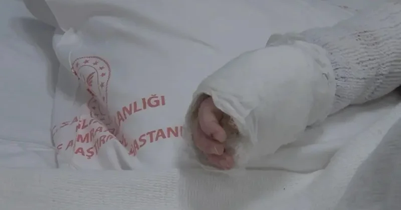 Üzərinə qaynar su tökülən 20 aylıq körpə evə buraxıldı