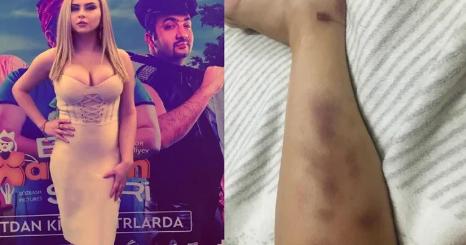 Aktrisa Ülfət Bəşir ikinci mərtəbədən yerə yıxıldı FOTO