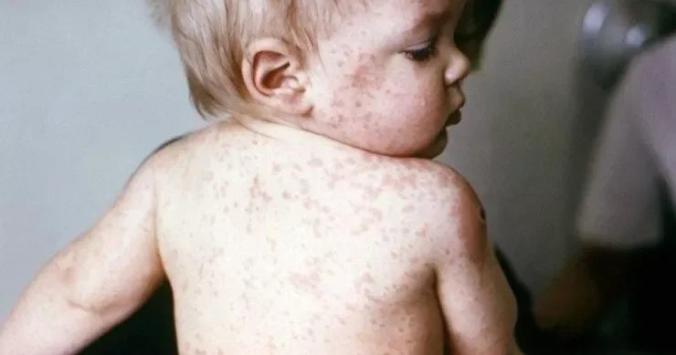 Bu uşaqlar arasında qızılcaya yoluxmalar artıb Pediatrdan xəbərdarlıq