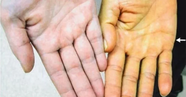 Dəridə saralma hansı xəstəliyin əlaməti ola bilər? Açıqlama