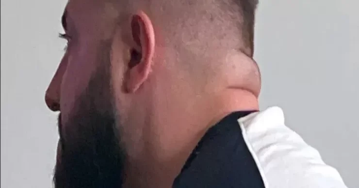 Boynunuzun qalın olması insult və diabet XƏBƏRDARLIĞIDIR