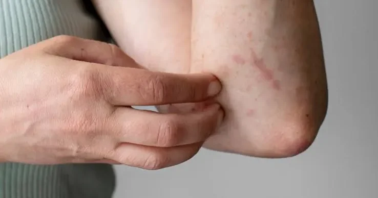 Çexiyada qoturluq epidemiyası YAYILDI