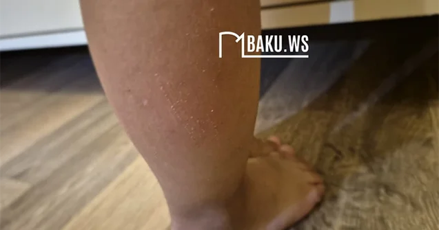 Lükə düşən uşaqla bağlı Açıqlama
