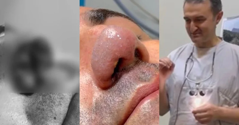 Burnunu it dişləyən xəstəyə yenisi formalaşdırıldı Video