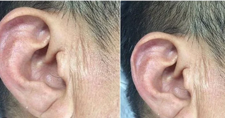 Qulaqdakı bu xətt infarktın xəbərçisidir? Rəşad Mahmudovdan açıqlama