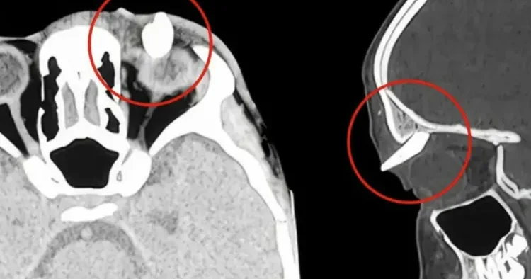 16 yaşlı yeniyetmənin qaşının altında diş çıxdı Dünyada İLK
