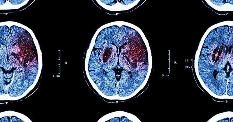 İnsultlar daha çox 55 yaşdan aşağı qruplarda olur