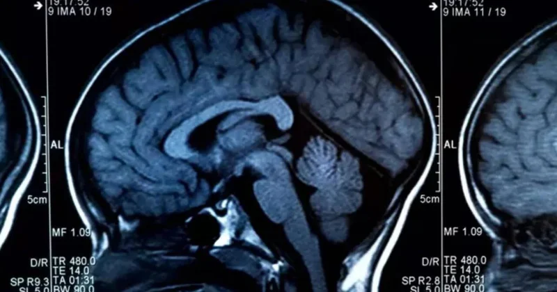 Beyni məhv edən qidalar açıqlandı Hər gün yeyirik