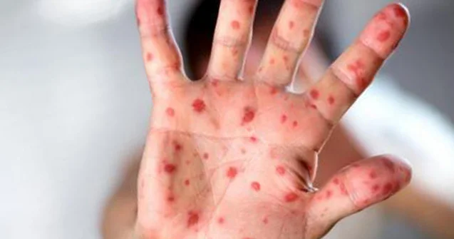 Ölkədə qızılca və suçiçəyi ilə bağlı vəziyyət necədir? Rəsmi