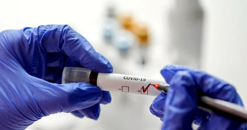 Azərbaycanda COVİD 19 a yoluxanlar var RƏSMİ