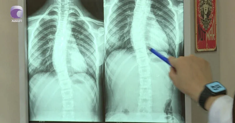 Son zamanlar “8 12” yaş arası uşaqlarda bel və boyun ağrılarının səbəbi