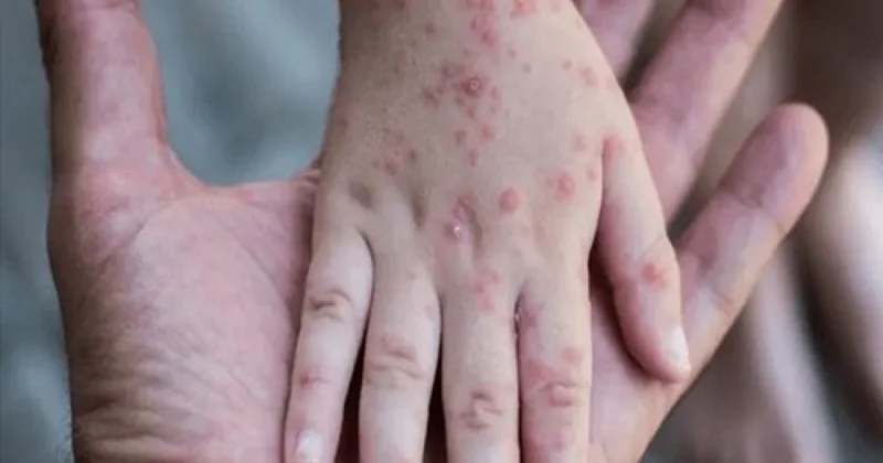 Оспа обезьян добралась до России Minval Politika