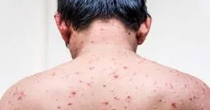 Rusiyada meymunçiçəyinə yoluxma aşkarlandı