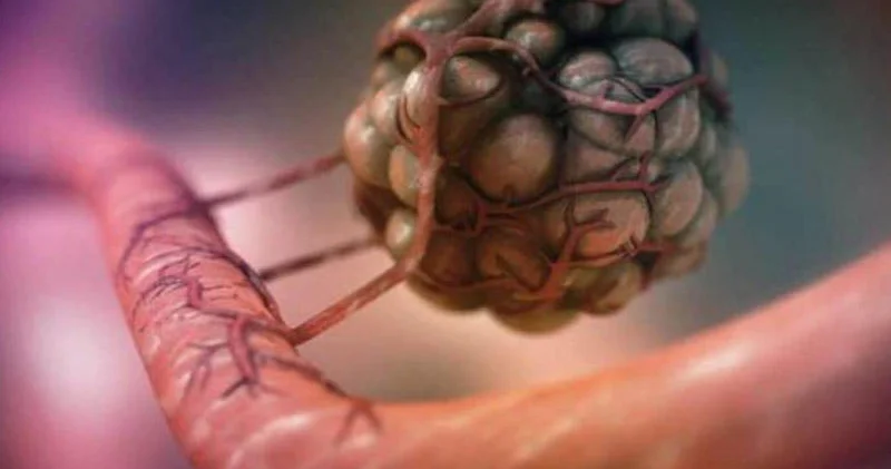 Xərçəng müalicəsində yeni dövr: Kemoterapiyasız tam sağalma