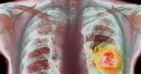 Siqaret çəkməyən insanlarda ağciyər xərçəngi ola bilərmi?