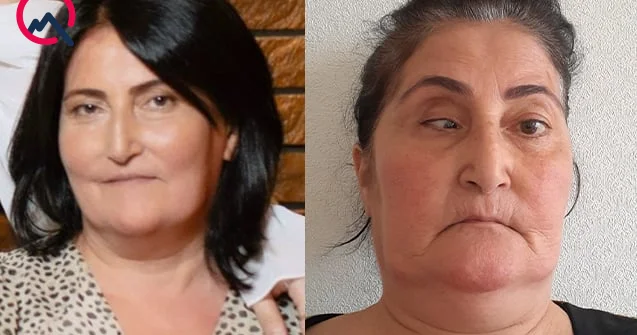 Bu klinika təzminat ödəyəcək Burun düzəldəndə gözü zədələyib