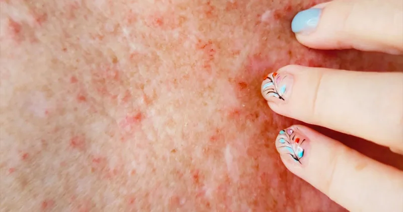 Yayda səpkilərindən necə qurtulmaq olar? Dermatoloqdan sadə tövsiyə