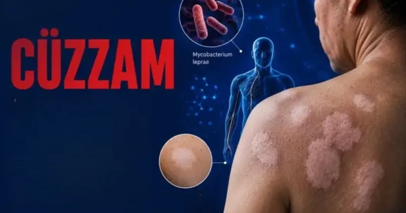 Cüzamla bağlı illərin qorxusu bitir Tam sağalmaq mümkündür” Həkim terapevt