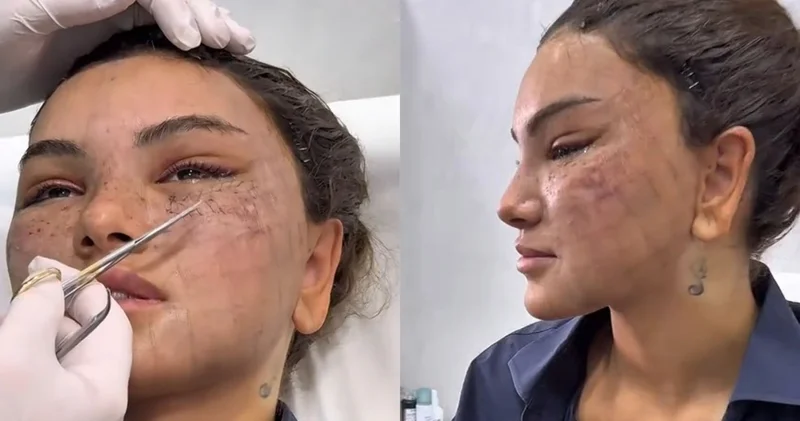 Estetik prosedurlardan sonra üzü tanınmaz hala düşdü VİDEO