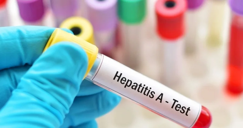 Çexiya hepatitə yoluxma sayına görə 40 illik rekordu qırıb