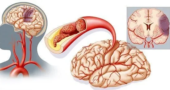 Beynin qan dövranı niyə pozulur? Həkim AÇIQLADI
