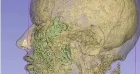 Filler sovrulur? Xeyr!