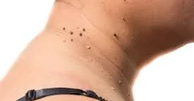 Papillomavirusların törətdiyi xəstəliklər və müalicəsi OMELOTERAPİYA