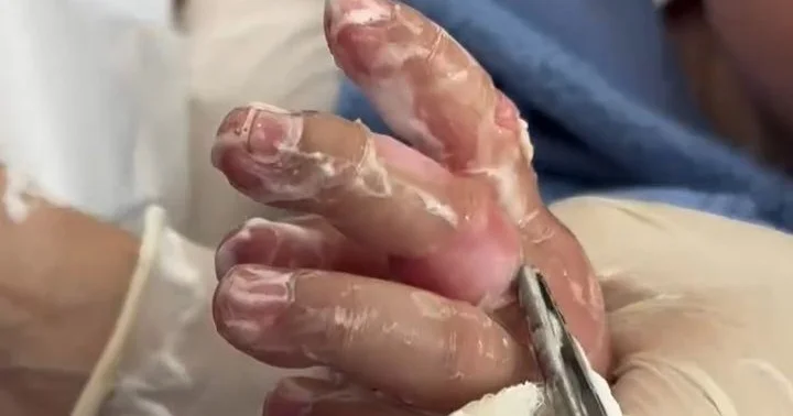 10 aylıq körpə yanıq xəsarəti aldı Əlini qaynar çaydana salıb... VİDEO