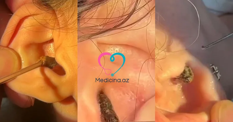 Qulağı pambıq çubuqlarla təmizləməyin nəticəsi Həkimdən xəbərdarlıq VİDEO