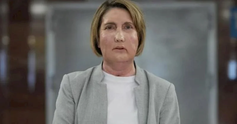 İspaniyada həkimlər evtanaziya ilə ölən qadının üzünü köçürdülər