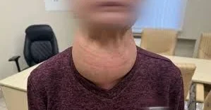 Qadının zobu baş ölçüsünə çatdı