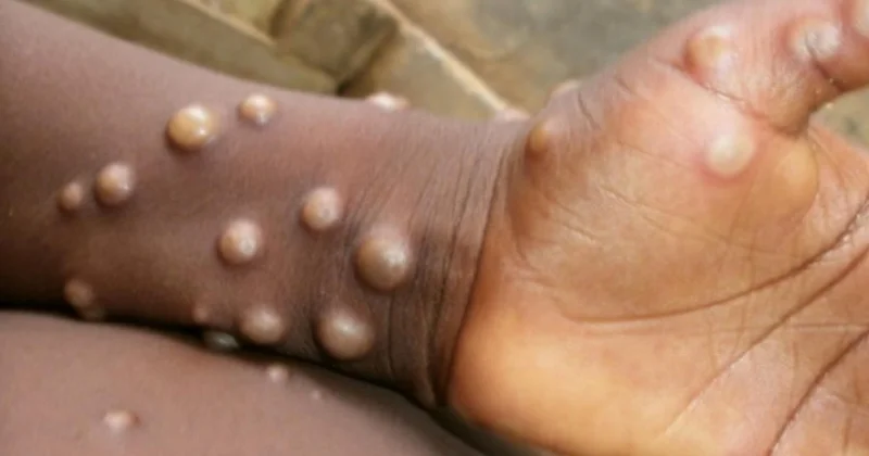 Meymunçiçəyi xəstəliyi necə yaranıb və insan orqanizminə hansı təsirlər göstərir?