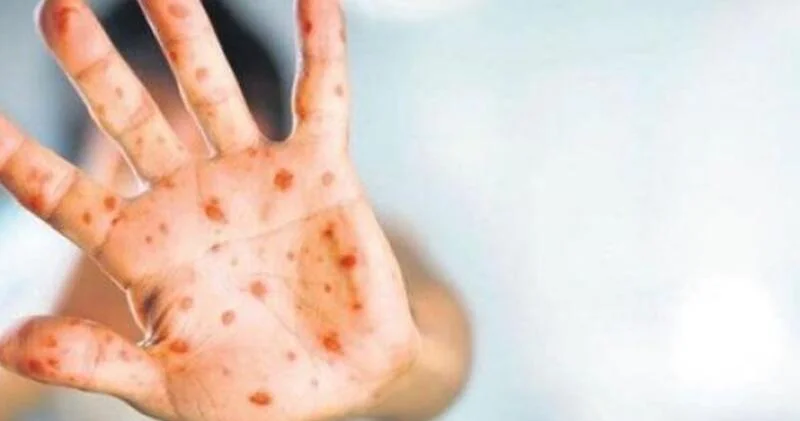 Meymunçiçəyi həmsərhəd ölkədə Azərbaycanda yoluxma qeydə alınıb?