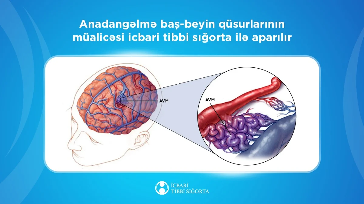 Bu əməliyyat da icbari tibbi sığorta ilə icra olunur