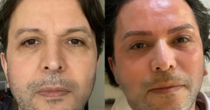 Nihat Doğan estetik etdirdi