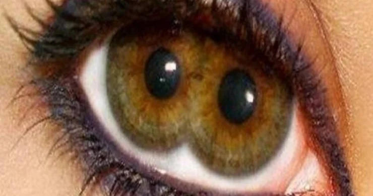 Pupula duplex nədir?