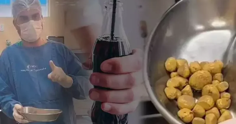 Gündə 3 litr kola içdi, sidik kisəsi daşla doldu Sosial mediada viral oldu