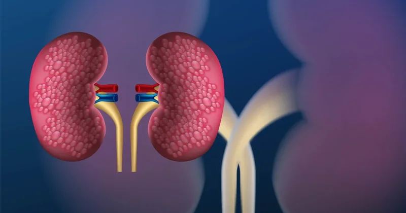 Böyrək daşlarının yaranmasına D vitamini çatışmazlığı da səbəb ola bilər