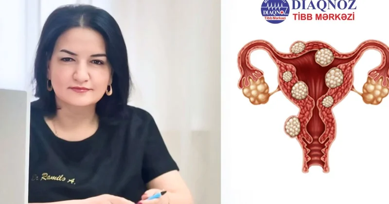Uşaqlıq mioması təhlükəlidirmi? Diaqnoz Tibb Mərkəzinin ginekoloqundan açıqlama