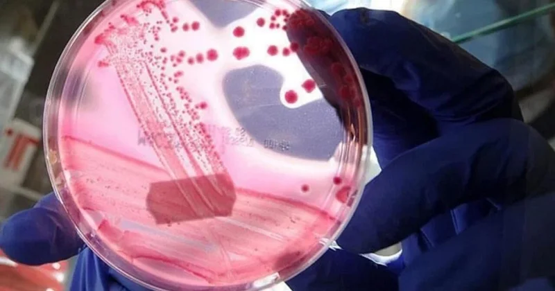 Kişilərdə ən çox rast gəlinən ikinci xərçəng növü hansıdır?