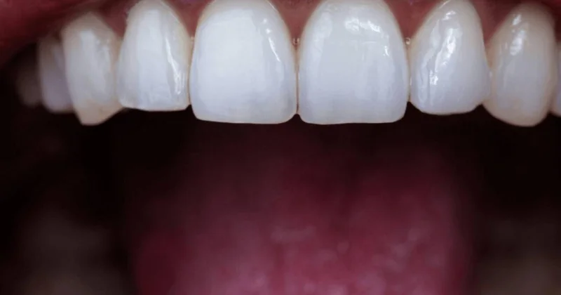 Dişlərin gizli düşməni açıqlandı