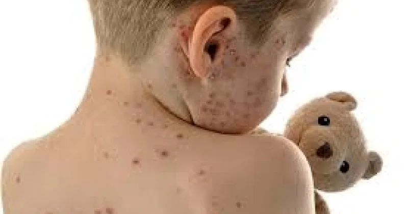 Uşaqlar arasında suçiçəyi xəstəliyi yayılıb VİDEO