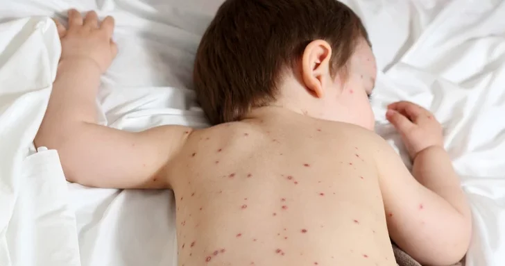 В Азербайджане регистрируются случаи ветряной оспы среди детей: важные рекомендации родителям