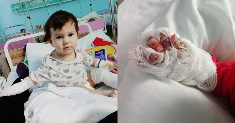 Əlləri və ayaqları yanan bir yaşlı körpənin yardıma ehtiyacı var