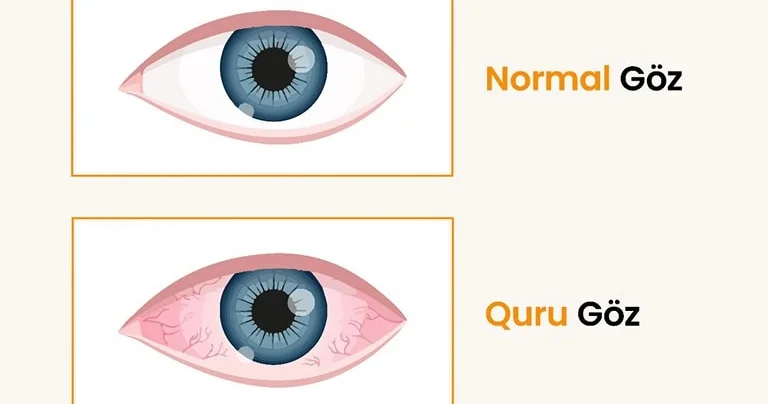 Göz quruluğu sindromu ekran istifadəsi ilə bağlı nə qədər yayılıb? ARAŞDIRMA
